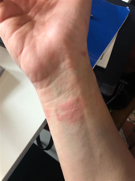 watch band allergic reaction